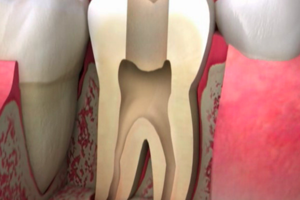 root-canal_2